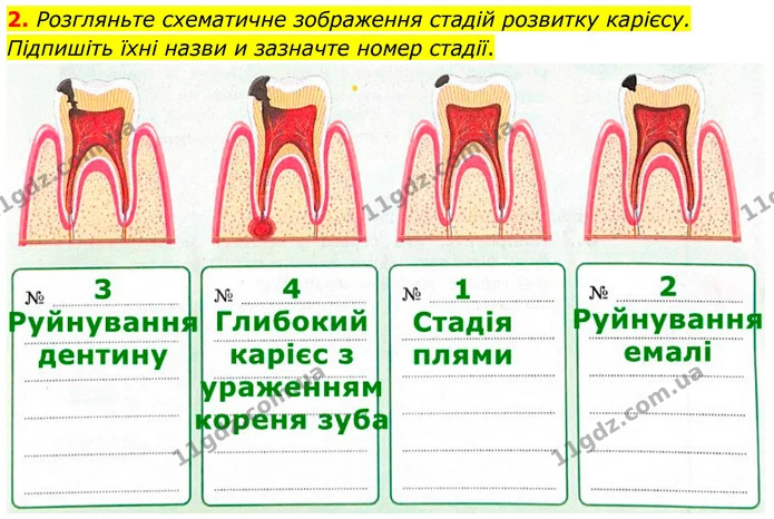 2. Розгляньте схематичне зображення стадій розвитку карієсу. Підпишіть їхні назви и зазначте номер стадії. — ГДЗ Робочий зошит Біологія 8 клас Тагліна (2025)